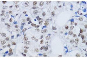 Immunohistochemistry of paraffin-embedded Human mammary cancer using DiMethyl-Histone H3-K79 Polyclonal Antibody at dilution of 1:200 (40x lens). (Histone 3 anticorps  (2meLys79))