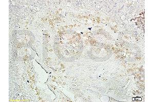 Formalin-fixed and paraffin embedded human ovary carcinoma with labeled Anti-Mtp53(N235K N239Y) Polyclonal Antibody, Unconjugated (ABIN729763) at 1:200, followed by conjugation to the secondary antibody and DAB staining