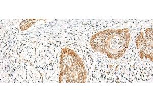 Immunohistochemistry of paraffin-embedded Human esophagus cancer tissue using HNF1A Polyclonal Antibody at dilution of 1:25(x200) (HNF1A anticorps)