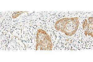 Immunohistochemistry of paraffin-embedded Human esophagus cancer tissue using HNF1A Polyclonal Antibody at dilution of 1:25(x200) (HNF1A anticorps)