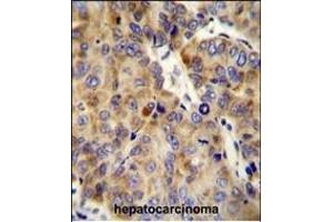 COL18A1 Antibody (Center) (ABIN654663 and ABIN2844359) immunohistochemistry analysis in formalin fixed and paraffin embedded human hepatocarcinoma followed by peroxidase conjugation of the secondary antibody and DAB staining. (COL18A1 anticorps  (AA 1311-1339))