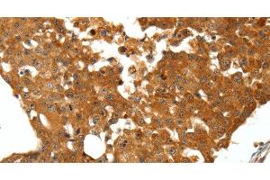 Immunohistochemistry of paraffin-embedded Human breast cancer tissue using SSTR1 Polyclonal Antibody at dilution 1:50