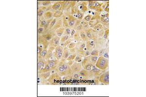 Formalin-fixed and paraffin-embedded human hepatocarcinoma tissue reacted with GRK7 Antibody , which was peroxidase-conjugated to the secondary antibody, followed by DAB staining. (GRK7 anticorps  (C-Term))