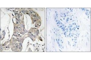 Immunohistochemistry analysis of paraffin-embedded human breast carcinoma, using MKP-1/2 (Phospho-Ser296/318) Antibody. (MKP-1/2 anticorps  (pSer296))