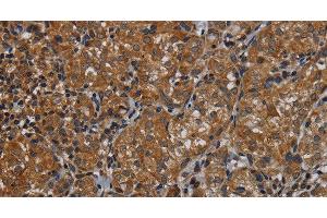 Immunohistochemistry of paraffin-embedded Human thyroid cancer tissue using IVL Polyclonal Antibody at dilution 1:50 (Involucrin anticorps)