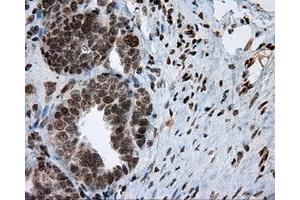 Immunohistochemical staining of paraffin-embedded Adenocarcinoma of breast tissue using anti-MCL1 mouse monoclonal antibody. (MCL-1 anticorps)