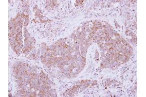 IHC-P Image Immunohistochemical analysis of paraffin-embedded human lung Papillary adenocarcinoma, using ADAM10, antibody at 1:250 dilution.
