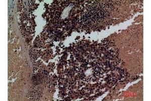 Immunohistochemistry (IHC) analysis of paraffin-embedded Human Lung Cancer, antibody was diluted at 1:100.