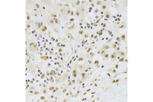 Immunohistochemistry of paraffin-embedded human liver cancer using PPP1R8 Antibody (ABIN5974046) at dilution of 1/100 (40x lens). (PPP1R8 anticorps)