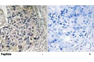Immunohistochemistry analysis of paraffin-embedded human prostate carcinoma tissue using SLC25A12 polyclonal antibody .
