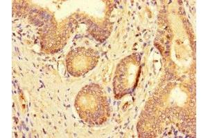 Immunohistochemistry of paraffin-embedded human prostate cancer using ABIN7174763 at dilution of 1:100 (C19ORF44 anticorps  (AA 101-400))