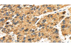 Immunohistochemistry of paraffin-embedded Human liver cancer tissue using SLC25A26 Polyclonal Antibody at dilution 1:30 (SLC25A26 anticorps)