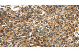 Immunohistochemistry of paraffin-embedded Human esophagus cancer using PRSS50 Polyclonal Antibody at dilution of 1:30 (PRSS50 anticorps)