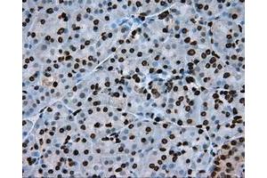 Immunohistochemical staining of paraffin-embedded Adenocarcinoma of colon tissue using anti-ARNTL mouse monoclonal antibody. (ARNTL anticorps)