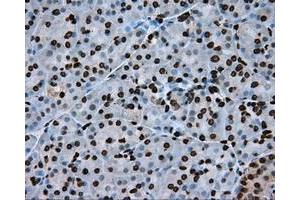 Immunohistochemical staining of paraffin-embedded Adenocarcinoma of colon tissue using anti-ARNTL mouse monoclonal antibody.