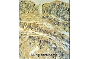 FKBP2 Antibody (N-term) (ABIN390690 and ABIN2840980) IHC analysis in formalin fixed and paraffin embedded human Colon carcinoma followed by peroxidase conjugation of the secondary antibody and DAB staining.