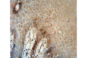 ITA6 antibody immunohistochemistry analysis in formalin fixed and paraffin embedded human skin carcinoma.