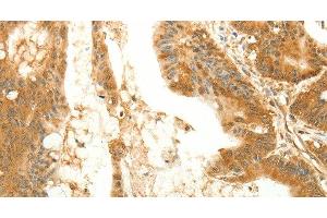 Immunohistochemistry of paraffin-embedded Human colon cancer tissue using RARRES1 Polyclonal Antibody at dilution 1:60