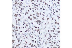 Immunohistochemistry of paraffin-embedded human liver cancer using [KO Validated] Histone H1.