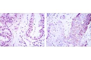 Immunohistochemical analysis of paraffin-embedded lung cancer (left) and esophagus cancer (right) using CRTC3 mouse mAb with DAB staining.