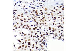 Immunohistochemistry of paraffin-embedded human breast cancer using K/K/TRIM28 Rabbit pAb  at dilution of 1:200 (40x lens). (KAP1 anticorps  (AA 576-835))