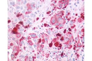 Anti-P2RY4 / P2Y4 antibody IHC of human Skin, Melanoma.