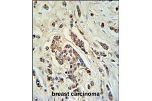ABCC11 Antibody (N-term) (ABIN650984 and ABIN2840023) IHC analysis in formalin fixed and paraffin embedded breast carcinoma followed by peroxidase conjugation of the secondary antibody and DAB staining. (ABCC11 anticorps  (N-Term))