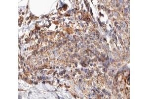 ABIN6266858 at 1/100 staining human Breast cancer tissue sections by IHC-P. (BCAR3 anticorps  (C-Term))