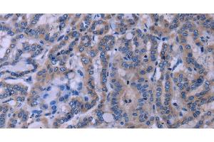 Immunohistochemistry of paraffin-embedded Human thyroid cancer tissue using TUBGCP2 Polyclonal Antibody at dilution 1:50