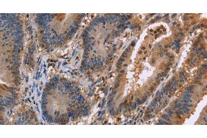 Immunohistochemistry of paraffin-embedded Human colon cancer tissue using FAAH2 Polyclonal Antibody at dilution 1:30