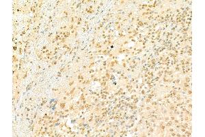 ABIN7094501 and ABIN7098550 at 1/100 staining Human liver cancer by IHC-P. (PRDM16 anticorps  (Internal Region))