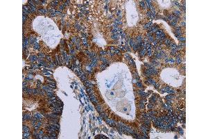 Immunohistochemistry of Human colon cancer using F11R Polyclonal Antibody at dilution of 1:40 (F11R anticorps)