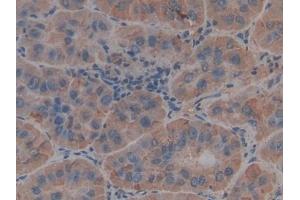 Detection of THBS1 in Human Liver cancer Tissue using Polyclonal Antibody to Thrombospondin 1 (THBS1)