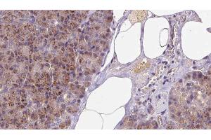 ABIN6273253 at 1/100 staining Human pancreas cancer tissue by IHC-P. (GSTM4 anticorps  (Internal Region))