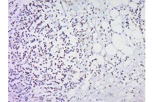 Paraformaldehyde-fixed, paraffin embedded Human Cervical cancer Antigen retrieval by boiling in sodium citrate buffer (pH6.