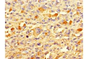 Immunohistochemistry of paraffin-embedded human melanoma using ABIN7172677 at dilution of 1:100 (TAF13 anticorps  (AA 1-124))