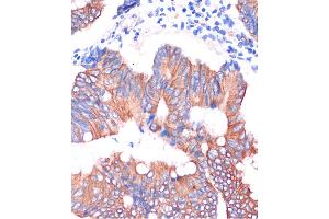 Immunohistochemistry of paraffin-embedded Human colon carcinoma using CGN Rabbit pAb (ABIN7266400) at dilution of 1:100 (40x lens). (Cingulin anticorps  (AA 904-1203))