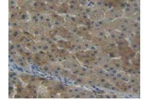 IHC-P analysis of Human Liver Cancer Tissue, with DAB staining. (NNMT anticorps  (AA 1-258))