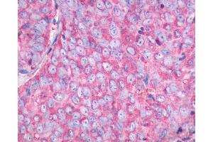 Anti-NMBR antibody IHC of human Ovary, Carcinoma. (NMBR anticorps  (C-Term))