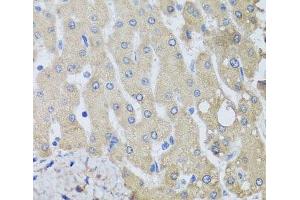 Immunohistochemistry of paraffin-embedded Human liver damage using NSF Polyclonal Antibody at dilution of 1:100 (40x lens). (NSF anticorps)