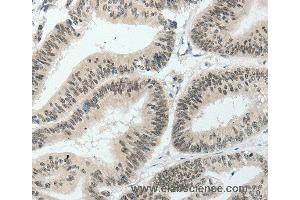 Immunohistochemistry of Human lung cancer using HNF1B Polyclonal Antibody at dilution of 1:80 (HNF1B anticorps)