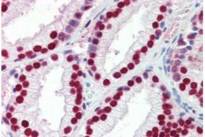 Human Prostate (formalin-fixed, paraffin-embedded) stained with SSB antibody ABIN462226 followed by biotinylated goat anti-rabbit IgG secondary antibody ABIN481713, alkaline phosphatase-streptavidin and chromogen.