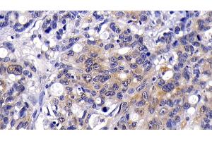 Detection of PKBa in Human Lymphoma Tissue using Polyclonal Antibody to Protein Kinase B Alpha (PKBa)