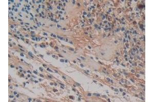 Detection of Hpt in Human Colorectal cancer Tissue using Polyclonal Antibody to Haptoglobin (Hpt)