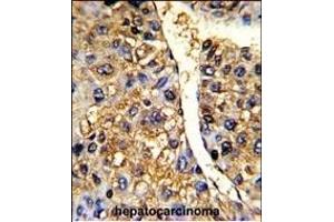 Formalin-fixed and paraffin-embedded human hepatocarcinoma reacted with TUFM Antibody (N-term), which was peroxidase-conjugated to the secondary antibody, followed by DAB staining.