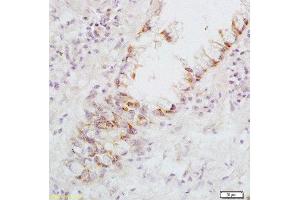 Formalin-fixed and paraffin embedded: human rectal carcinoma labeled with Anti-FasL Polyclonal Antibody, Unconjugated  at 1:200, followed by conjugation to the secondary antibody and DAB staining