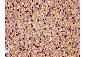 IHC image of ABIN7153853 diluted at 1:200 and staining in paraffin-embedded human glioma performed on a Leica BondTM system.