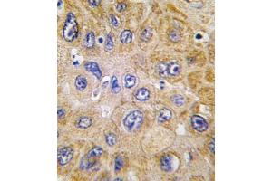 Formalin-fixed and paraffin-embedded human hepatocarcinoma tissue reacted with THY1 antibody (N-term) (ABIN388803 and ABIN2839126) , which was peroxidase-conjugated to the secondary antibody, followed by DAB staining. (CD90 anticorps  (N-Term))