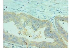 Immunohistochemistry of paraffin-embedded human colon cancer using ABIN7147898 at dilution of 1:100 (Claudin 2 anticorps  (AA 30-230))