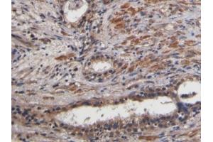Detection of CTGF in Human Prostate Tissue using Polyclonal Antibody to Connective Tissue Growth Factor (CTGF)
